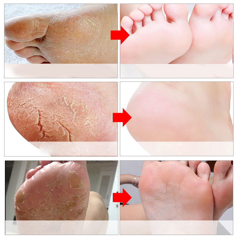 มาส์กขัดผิวเท้า ถุงเท้าขัดเท้า - Foot Mask Peeling บทวิจารณ์และราคา